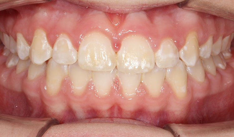 Class II orthodontic treatment after - patient 2