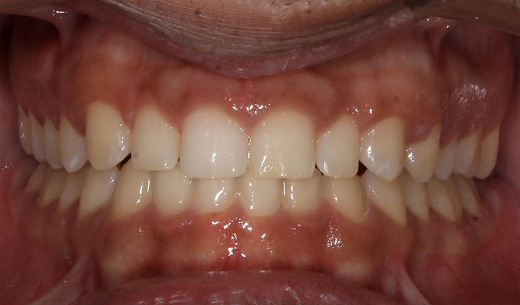 Spacing orthodontic treatment after - patient 2