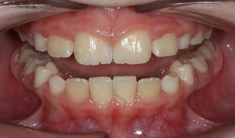 Phase I orthodontic treatment after - patient 2