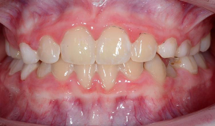 Invisalign First orthodontic treatment after - patient 2