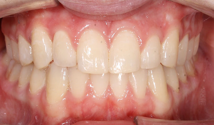 Combo TX orthodontic treatment after - patient 2