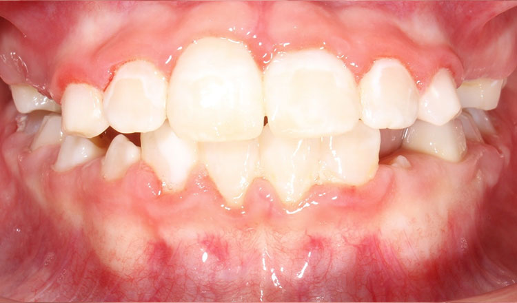 Crossbite orthodontic treatment after - patient 2