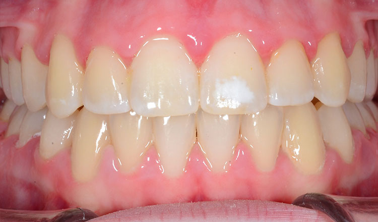 Crowding orthodontic treatment after - patient 2