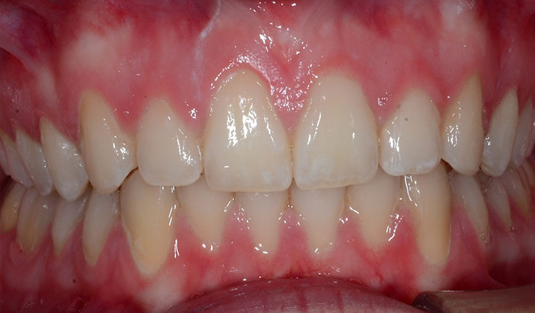 Deepbite orthodontic treatment after - patient 2