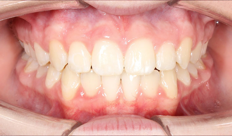 High Canines orthodontic treatment after - patient 2