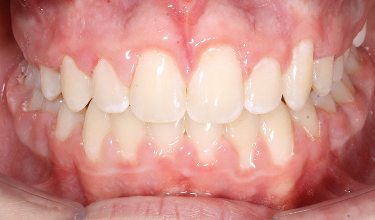 Impacted Canines orthodontic treatment after - patient 2
