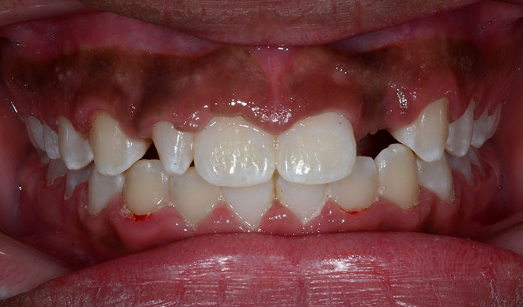 Missing Teeth orthodontic treatment after - patient 2