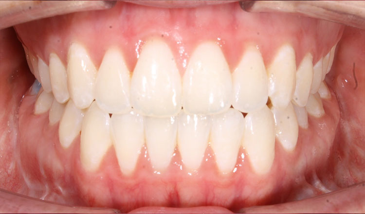 Open Bite orthodontic treatment after - patient 2