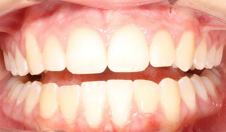 Both Phases orthodontic treatment after - patient 2