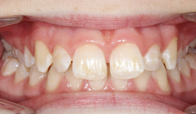 Class II orthodontic treatment before - patient 2