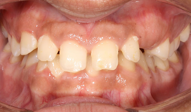 Spacing orthodontic treatment before - patient 2