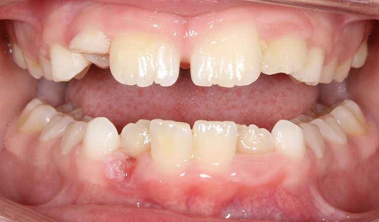Phase I orthodontic treatment before - patient 2