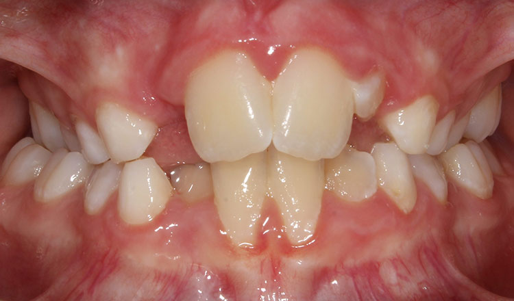 Invisalign First orthodontic treatment before - patient 2