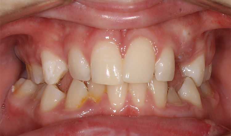 Combo TX orthodontic treatment before - patient 2