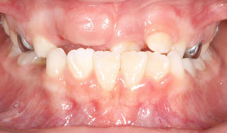 Crossbite orthodontic treatment before - patient 2