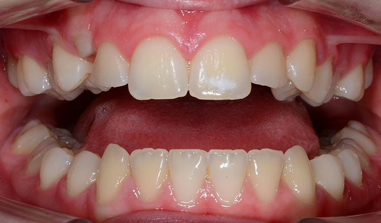 Crowding orthodontic treatment before - patient 2