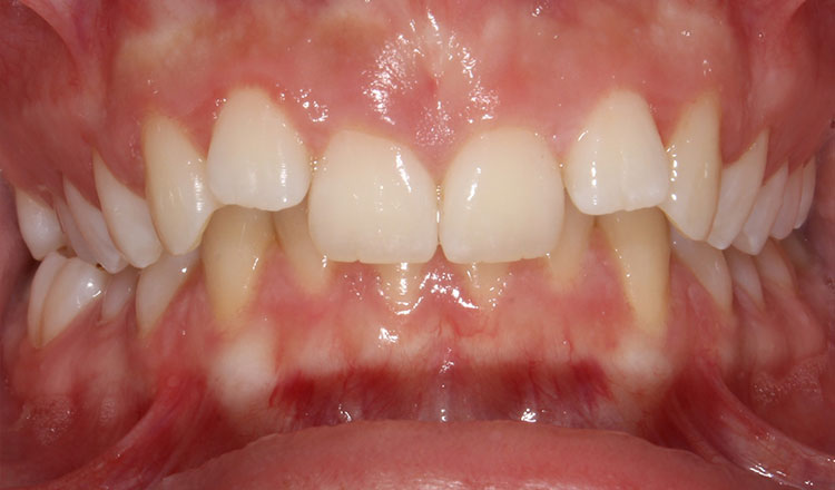 Deepbite orthodontic treatment before - patient 2