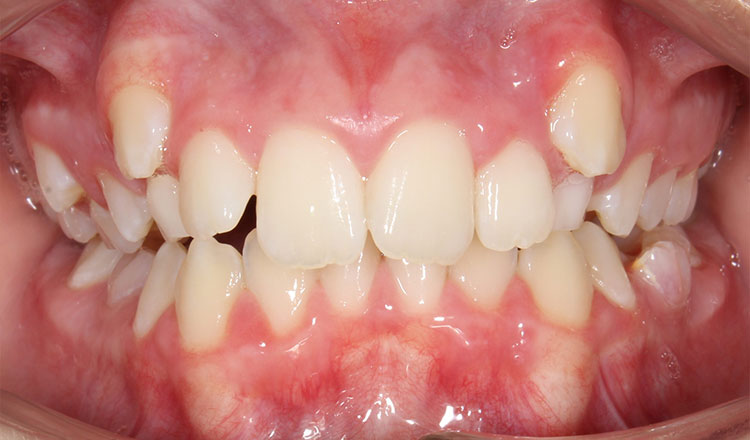 High Canines orthodontic treatment before - patient 2