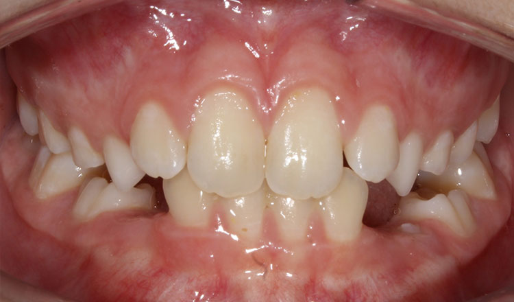 Impacted Canines orthodontic treatment before - patient 2
