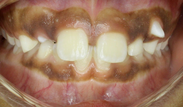 Missing Teeth orthodontic treatment before - patient 2