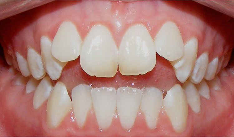 Open Bite orthodontic treatment before - patient 2