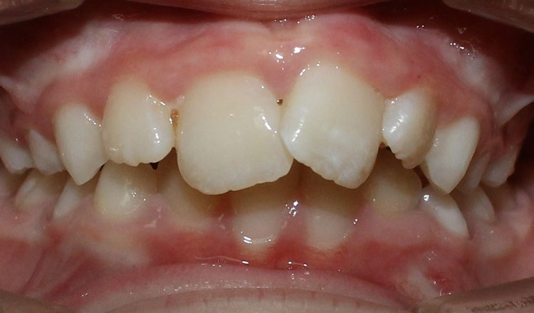 Both Phases orthodontic treatment before - patient 2