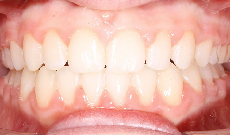 Class II orthodontic treatment after - patient 3