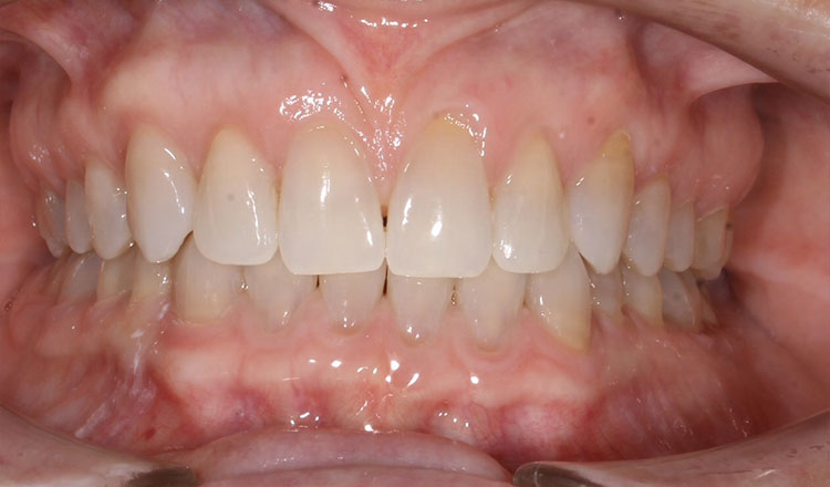Spacing orthodontic treatment after - patient 3
