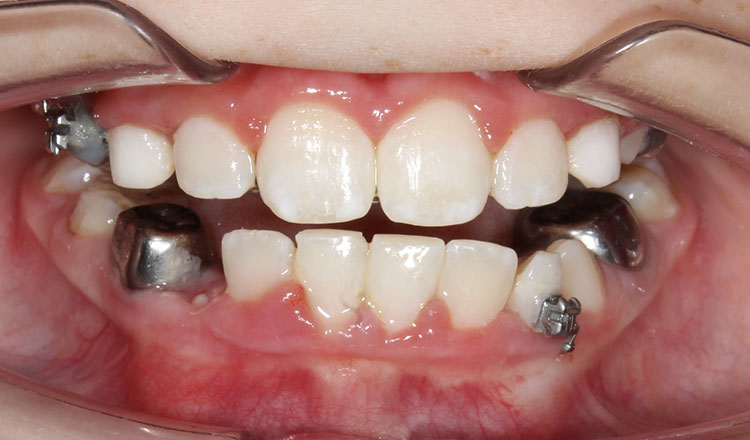 Phase I orthodontic treatment after - patient 3