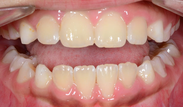 Combo TX orthodontic treatment after - patient 3