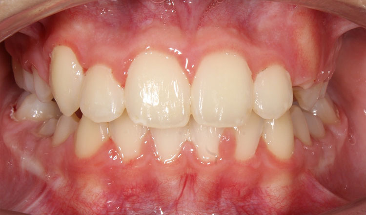 Crossbite orthodontic treatment after - patient 3