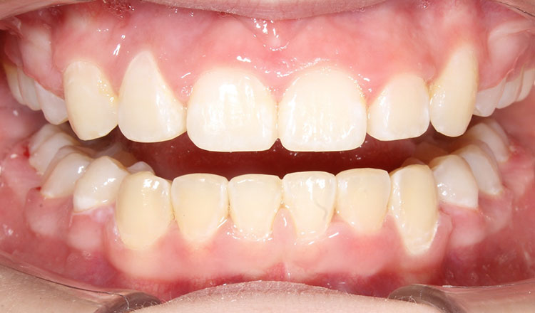 Crowding orthodontic treatment after - patient 3