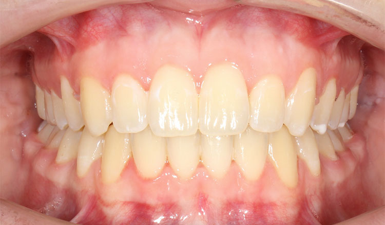 Deepbite orthodontic treatment after - patient 3