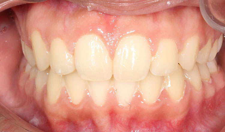 High Canines orthodontic treatment after - patient 3