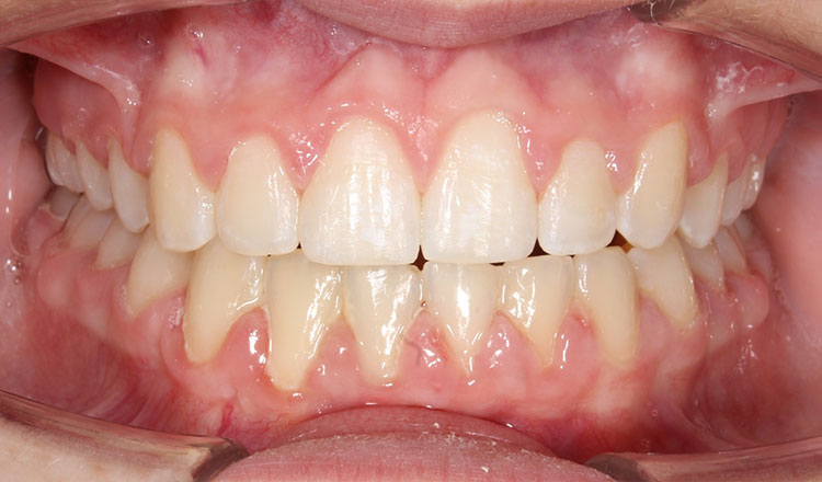 Impacted Canines orthodontic treatment after - patient 3