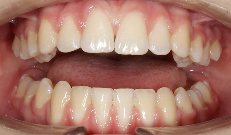 Missing Teeth orthodontic treatment after - patient 3