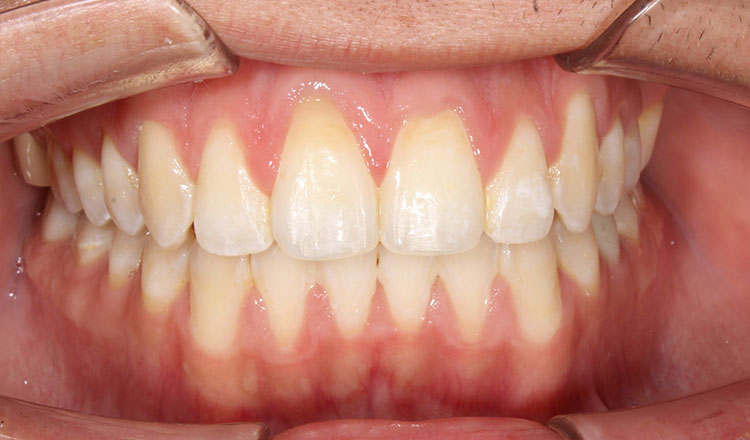 Open Bite orthodontic treatment after - patient 3
