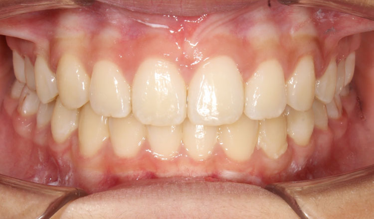 Both Phases orthodontic treatment after - patient 3