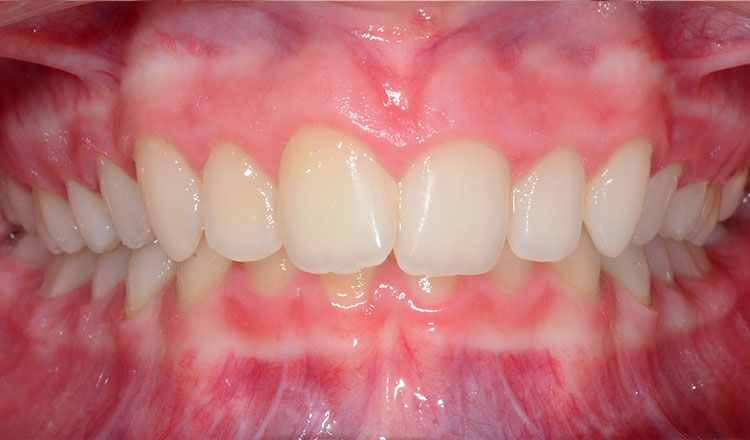 Class II orthodontic treatment before - patient 3