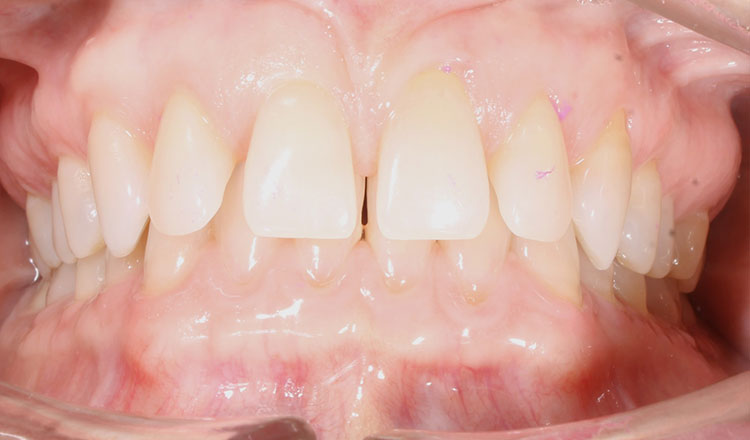 Spacing orthodontic treatment before - patient 3