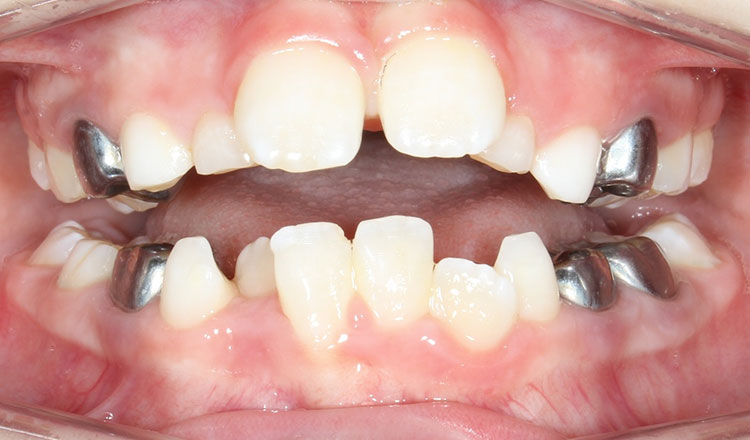 Phase I orthodontic treatment before - patient 3