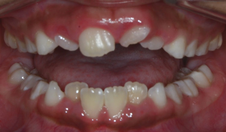 Combo TX orthodontic treatment before - patient 3