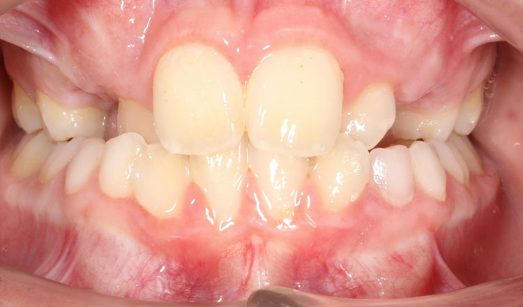 Crossbite orthodontic treatment before - patient 3