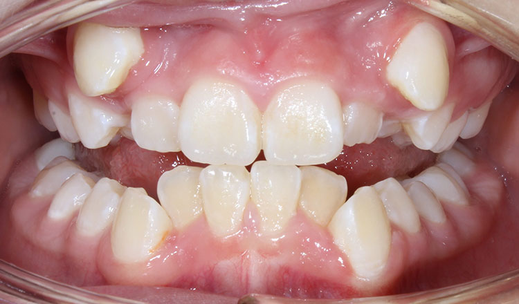 Crowding orthodontic treatment before - patient 3