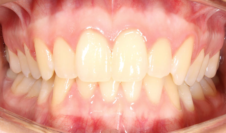 Deepbite orthodontic treatment before - patient 3