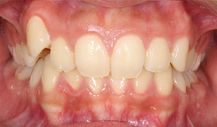 High Canines orthodontic treatment before - patient 3