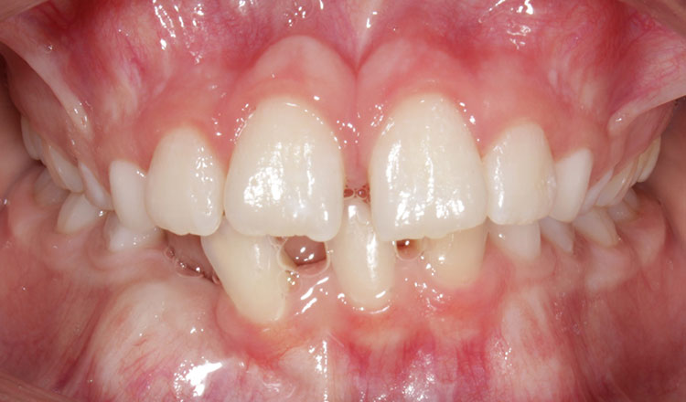 Impacted Canines orthodontic treatment before - patient 3
