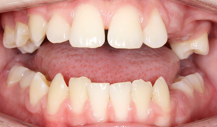 Missing Teeth orthodontic treatment before - patient 3