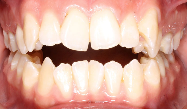 Open Bite orthodontic treatment before - patient 3
