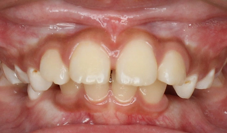 Both Phases orthodontic treatment before - patient 3